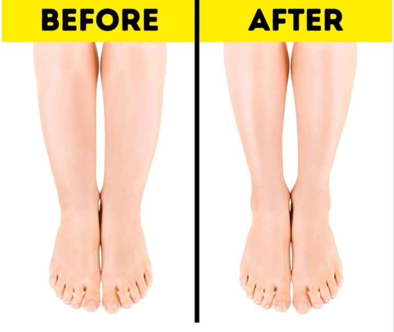 How To Get Rid Of Cankles