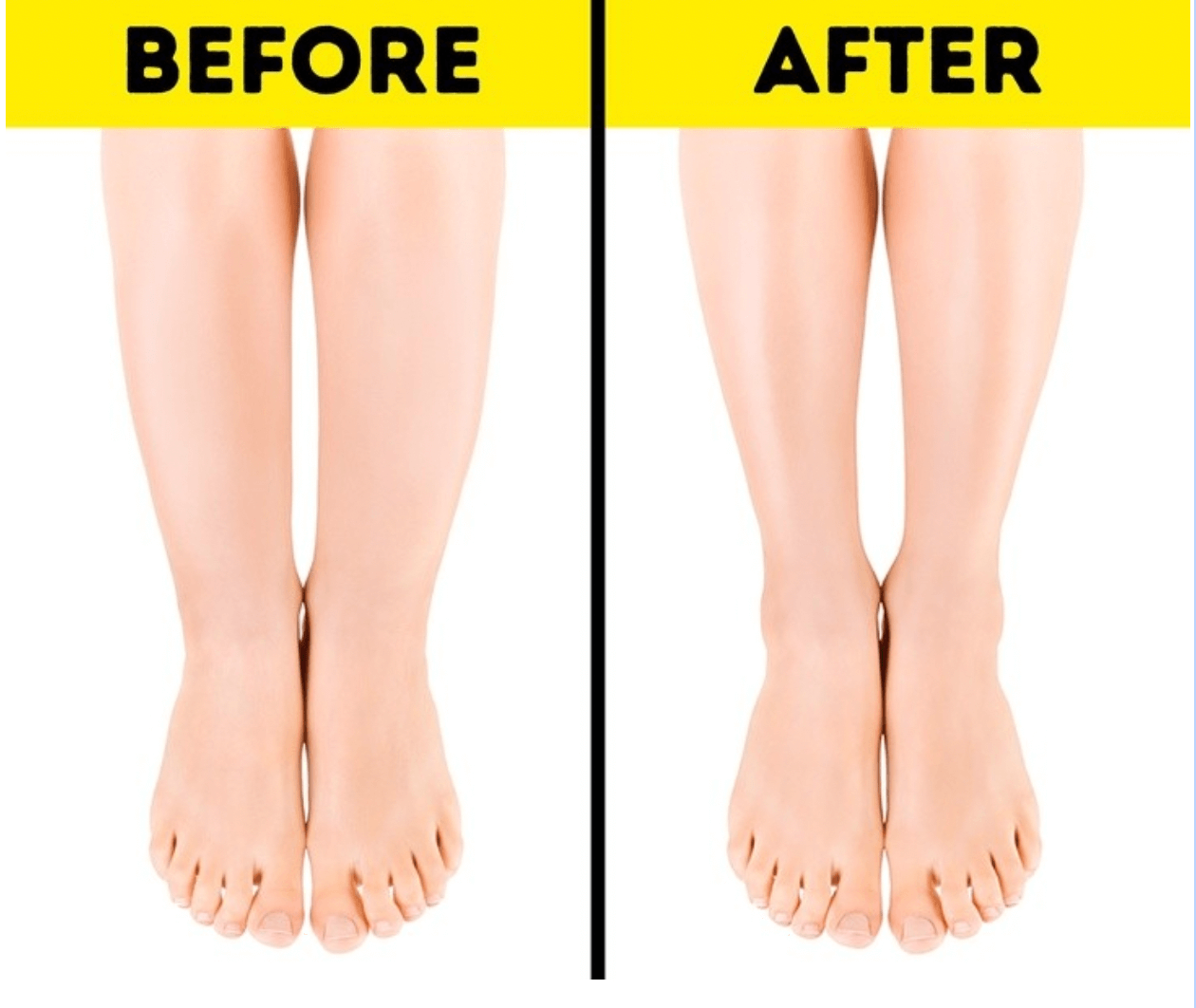 How To Get Rid Of Cankles